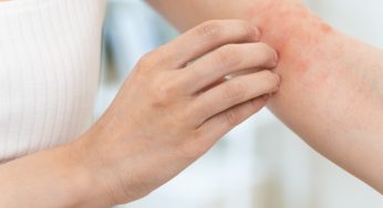 Desarrollarán tratamiento contra la dermatitis atópica