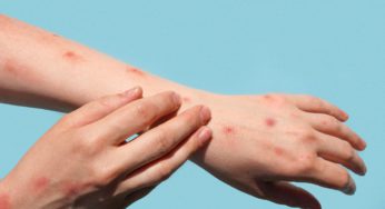 Viruela del Mono / Mpox, ¿Por qué es emergencia internacional de nuevo?